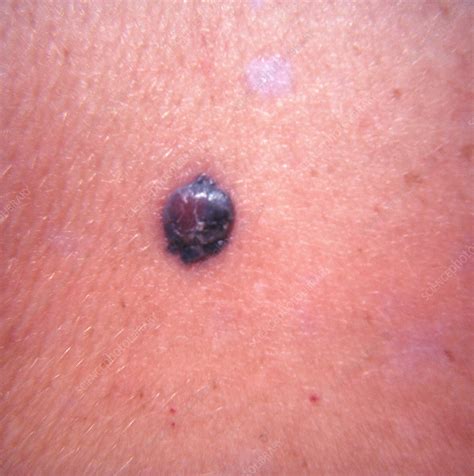 Nodular Malignant Melanoma Stock Image C0430672 Science Photo