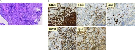 Histopathological Findings In Tissue Obtained From The Right Lung A