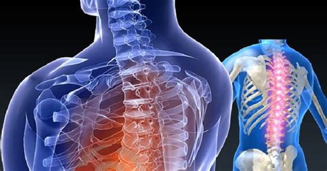 Spine Surgery Types Recovery Risks And Benefits Articlecube