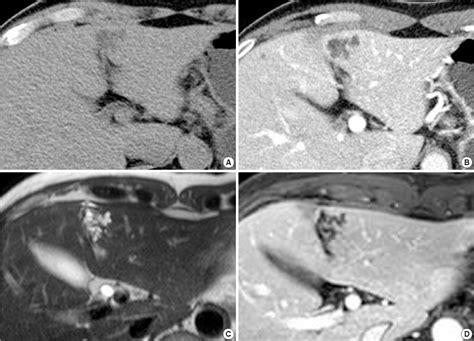 Figure From Multicystic Biliary Hamartoma Of The Liver Semantic Scholar