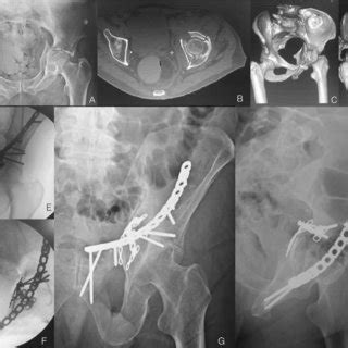 A Axial View Of Ct Scan B Coronal View Of Ct Scan C D Reconstruction