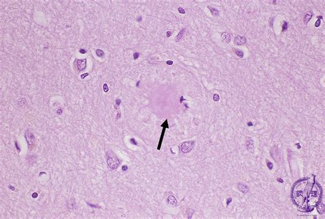 17 Nervous System 4 Alzheimer Type Dementia Pathology Core Pictures