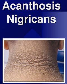 7 Acanthosis Nigricans/Diabetes Resources ideas | acanthosis nigricans ...