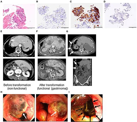 Frontiers Case Reports Transformation Of End Stage Neuroendocrine