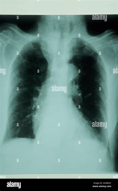 Los Rayos X Enfisema Pulmonar Fotograf A De Stock Alamy