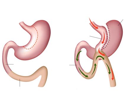 Mini Gastric Bypass Surgery Or Single Anastomosis Gastric Bypass