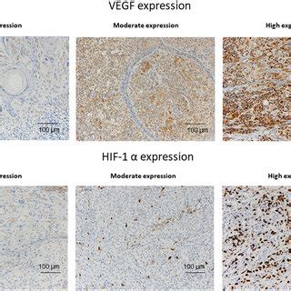 Representative Examples Of Vegf And Hif Expression According To