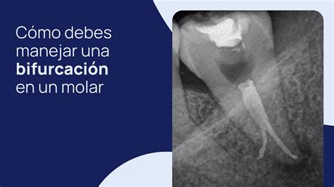 Aprende a manejar molares fusionados con bifurcación del conducto