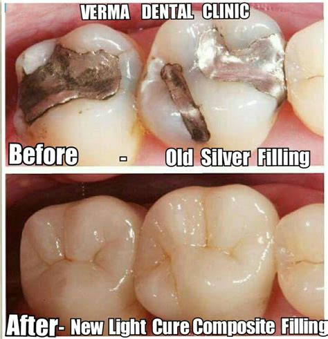 Improving Oral And Dental Health By Dr Amit Verma Lybrate