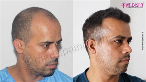 Best Hair Restoration Results In India