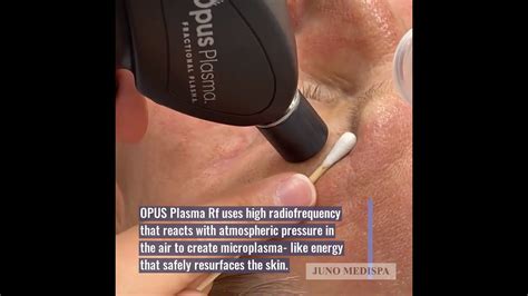 Opus Plasma Rf Skin Resurfacing At Junomedispa Youtube