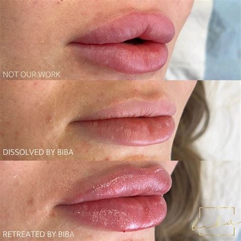 Lip Fillers Lip Injections Enhancements Parramatta