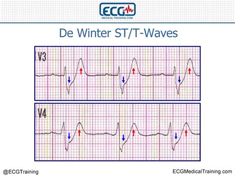 Medical English - Medical Informations: De Winter ST/T-Waves: Dấu De Winter