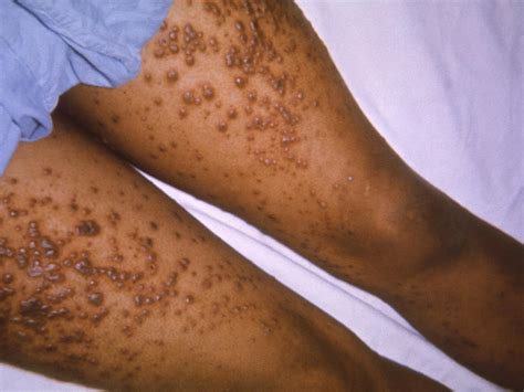 Adult Chicken Pox Look Like Telegraph