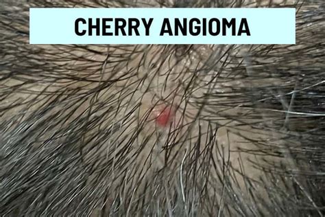 Red Spots on Scalp: 11 Causes, Pictures and Treatment