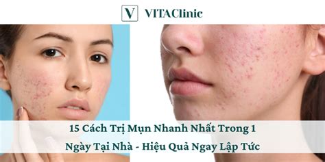 15 Cách Trị Mụn Nhanh Nhất Trong 1 Ngày Tại Nhà Hiệu Quả Ngay Lập Tức