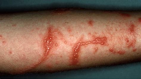 Dermatitis Contact Atopic Perioral Nummular Seborrheic Stasis