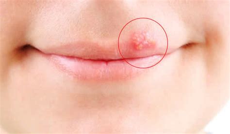 Herpes Labial Tratamento O Que Sintomas Causa E Mais The Best Porn