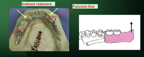 Lecture 4 Components Part 2 Indirect Retainers Flashcards Quizlet