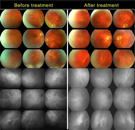 Why Birdshot Retinochoroiditis Should Rather Be Called ‘hla A29 Uveitis