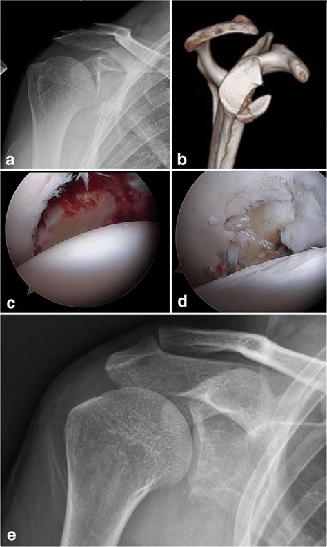 Arthroscopically Assisted Internal Fixation Of A Displaced Fracture Of