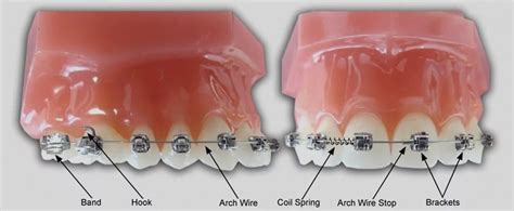 Braces Info In Bentleigh And Wodonga You Make Me Smile Orthodontics