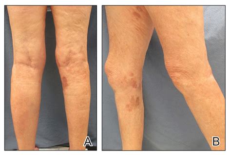 Nephrogenic Systemic Fibrosis Gadolinium