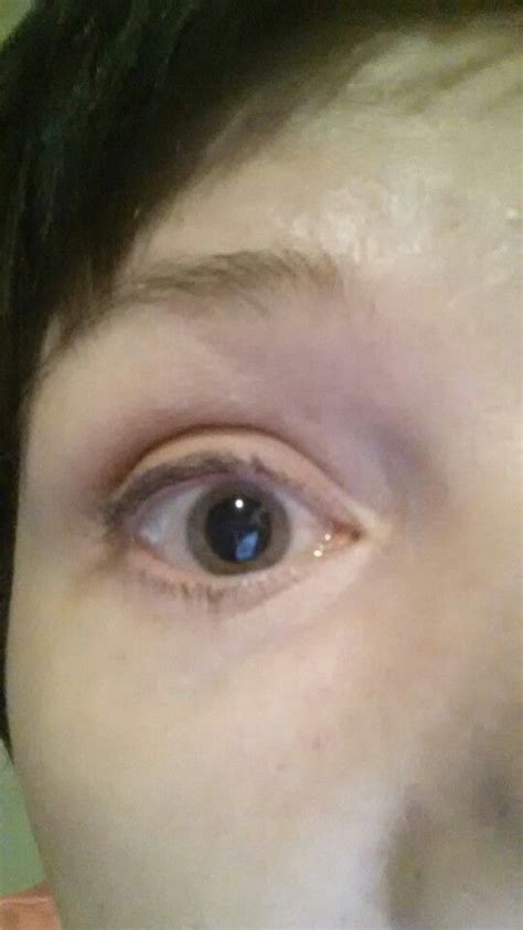 Dilated Pupils On Acid