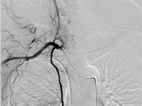 B D Digital Subtraction Angiography Shows The Difference Between An