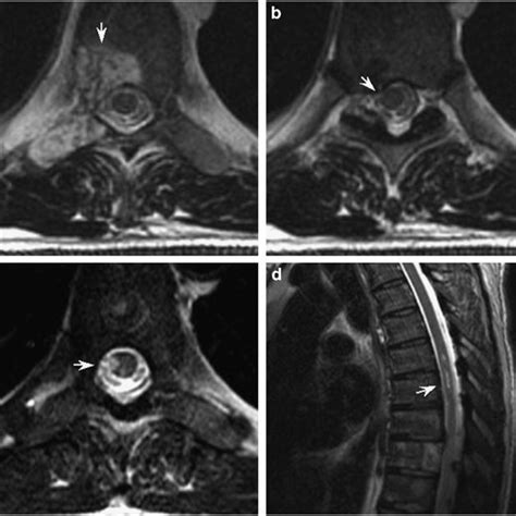 Anteroposterior View Spinal Angiogram Showing A Right Hemangioma In The