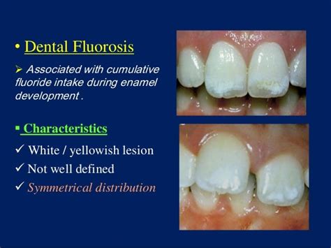 White Spot Lesions