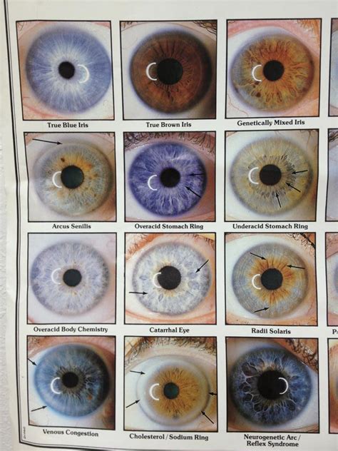 A Iris Signs Chart Iridology Eye Color Chart Rare Eye Colors | The Best ...