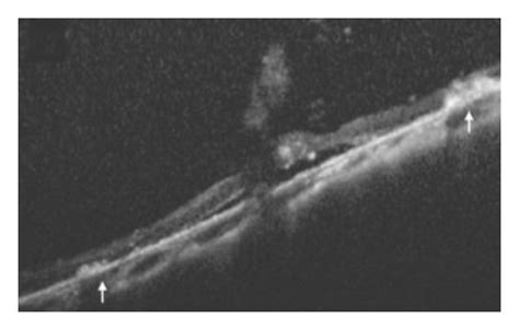 Peripheral SD-OCT before and after laser retinopexy for cystic retinal ...