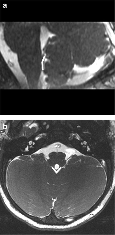 Normal Mr Appearance Of The Tela Choroidea In A 10 Month Old Boy A B