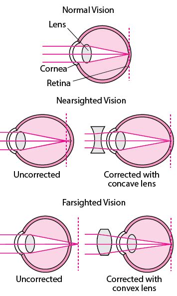 Figure: Understanding Refraction - MSD Manual Consumer Version