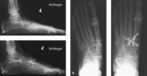 Arthrodesis of the Tarsometatarsal Joint | Plastic Surgery Key