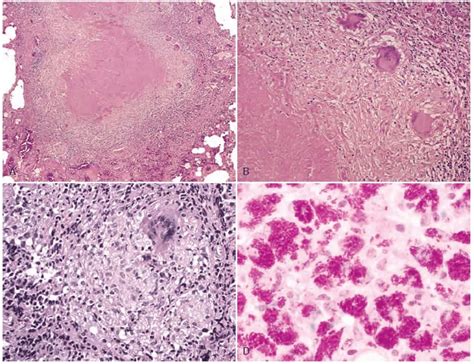 Tuberkulosis Tb Patofisiologi Diagnosis And Tatalaksana Kedokteran