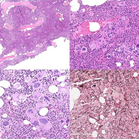 Polycythemia Vera Bone Marrow Is Markedly Hypercellular With