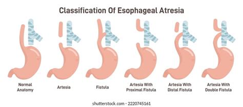 Esophageal Atresia