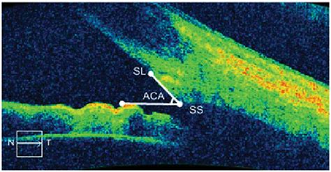 The anterior chamber angle measurement. SS: Scleral spur; SL: Schwalbe ...
