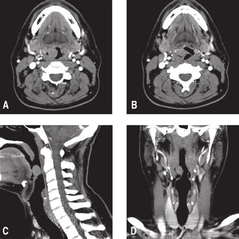 A, Drug-induced sleep endoscopy revealed a right-sided mass in the... | Download Scientific Diagram