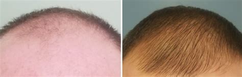 I Have Been On Finasteride Now For 9 Months What Do You Think Photo