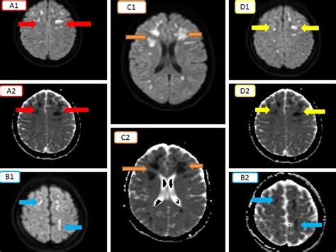 Bacterial Meningitis Brain Mri