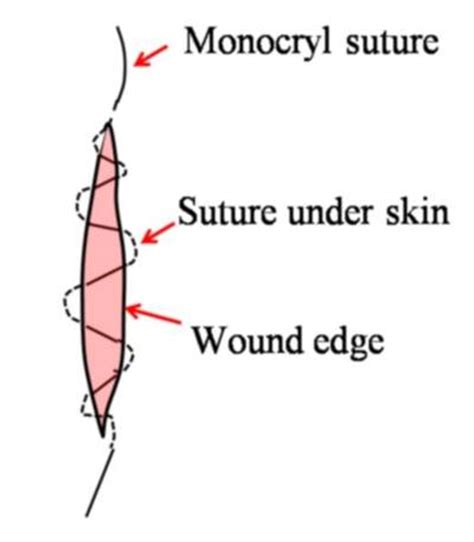 Subcuticular Suture