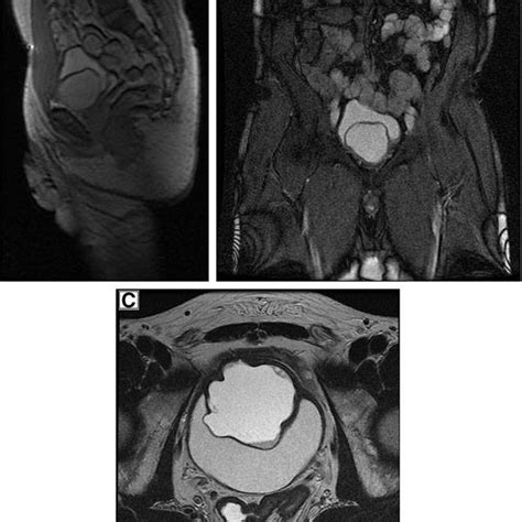 Mri Pelvis Prostate Showing The Well Defined Cystic Lesion A 3pl Loc Download Scientific