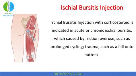 Ischial Bursitis