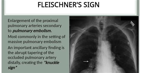 Chest Medicine Made Easy Dr Deepu Fleischners Sign