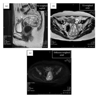 Findings Of Pelvic Magnetic Resonance Images Mri A And B