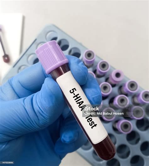 Blood Sample For 5hiaa Test Stock Photo - Download Image Now - iStock