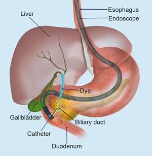 Ercp Procedure Bile Obstruction